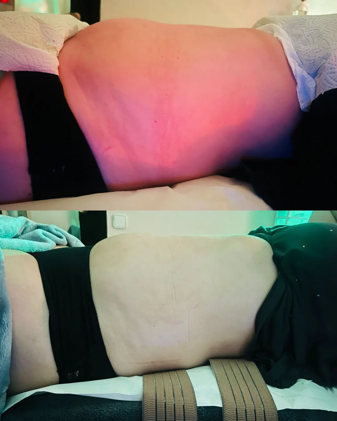 Antes y después de tratamiento corporal con radiofrecuencia y cavitación en Studio Virginia Falcão Cambrils — sesión real de cabina